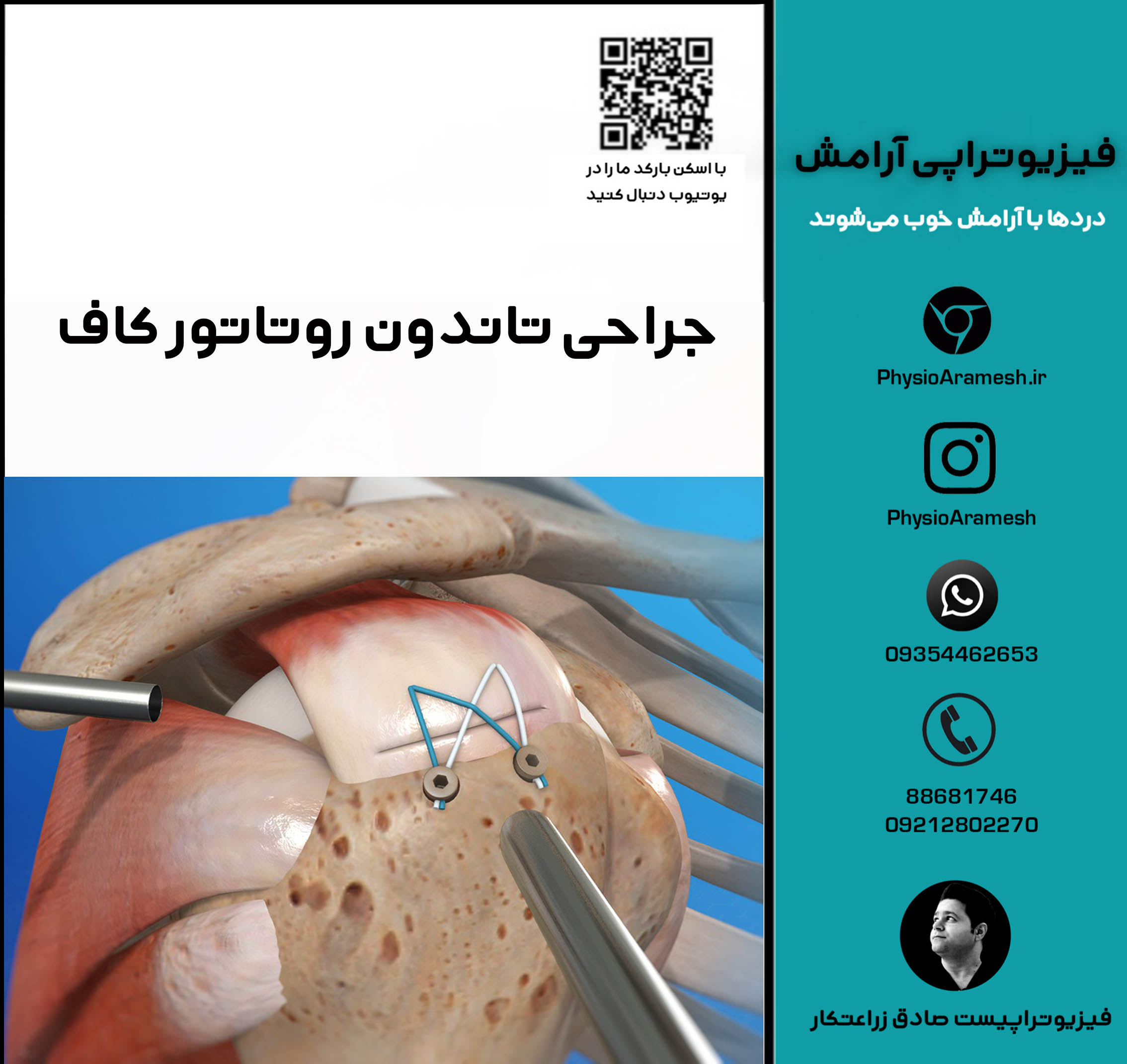 جراحی تاندون روتاتور کاف